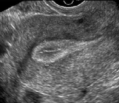 uterine lining development